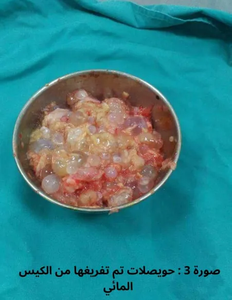 الكيس المائي الطفيلي في الكبد: التشخيص والعلاج والوقاية